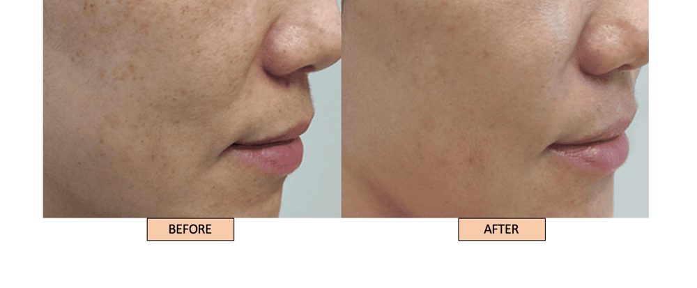 Klinik Dr Inder patient, pigmentation before and after Pico laser